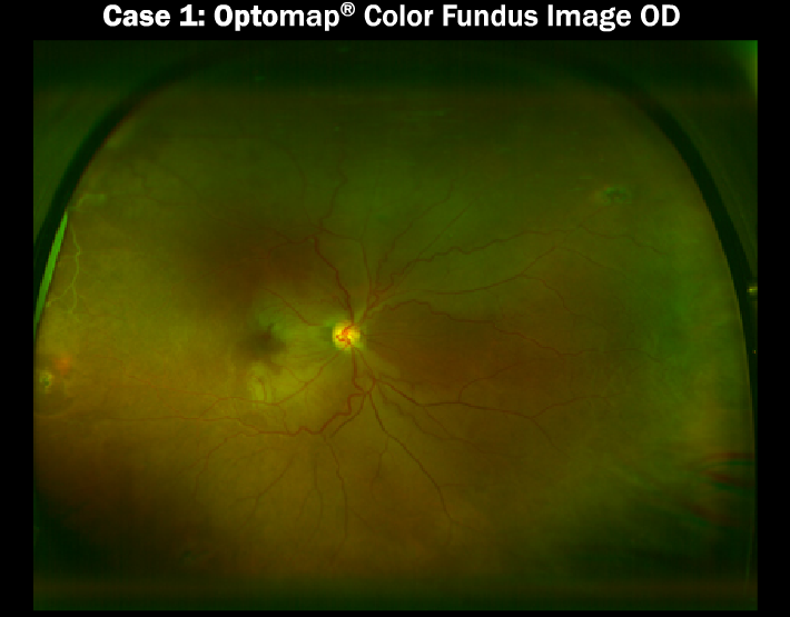 Case 49: Case 1: Optomap Color Fundus Image OD