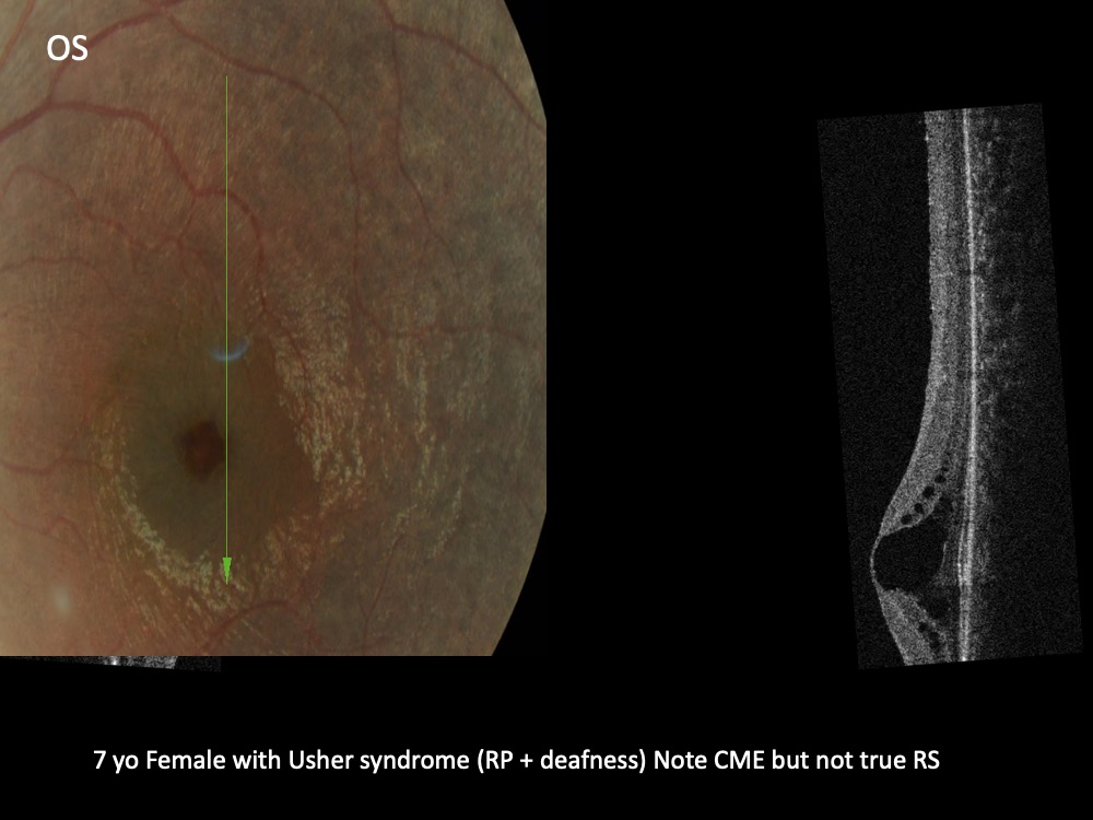 7 yo Female with Usher syndrome (RP + deafness) Note CME but not true RS
