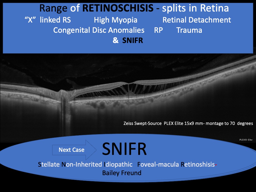 SNIFR Stellate Non-Inherited Idiopathic Foveal-macula Retinoshisis- Bailey Freund