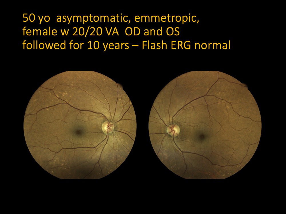 50 yo asymptomatic, emmetropic, female w 20/20 VA OD and OSfollowed for 10 years – Flash ERG normal
