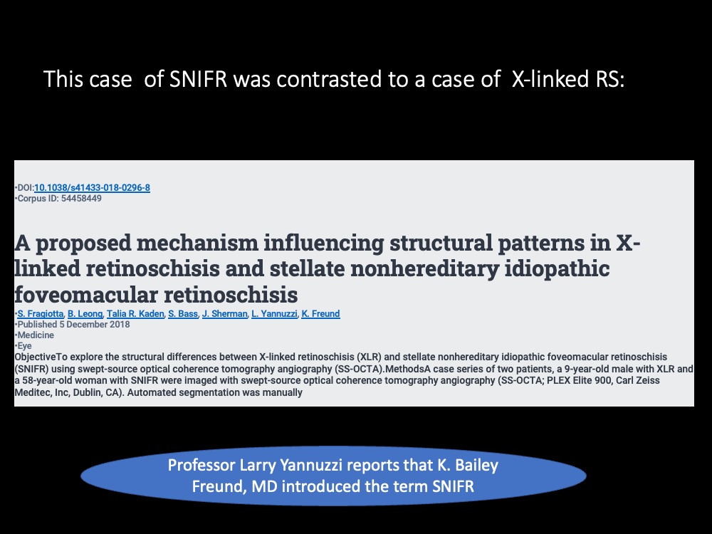 This case of SNIFR was contrasted to a case of X-linked RS: